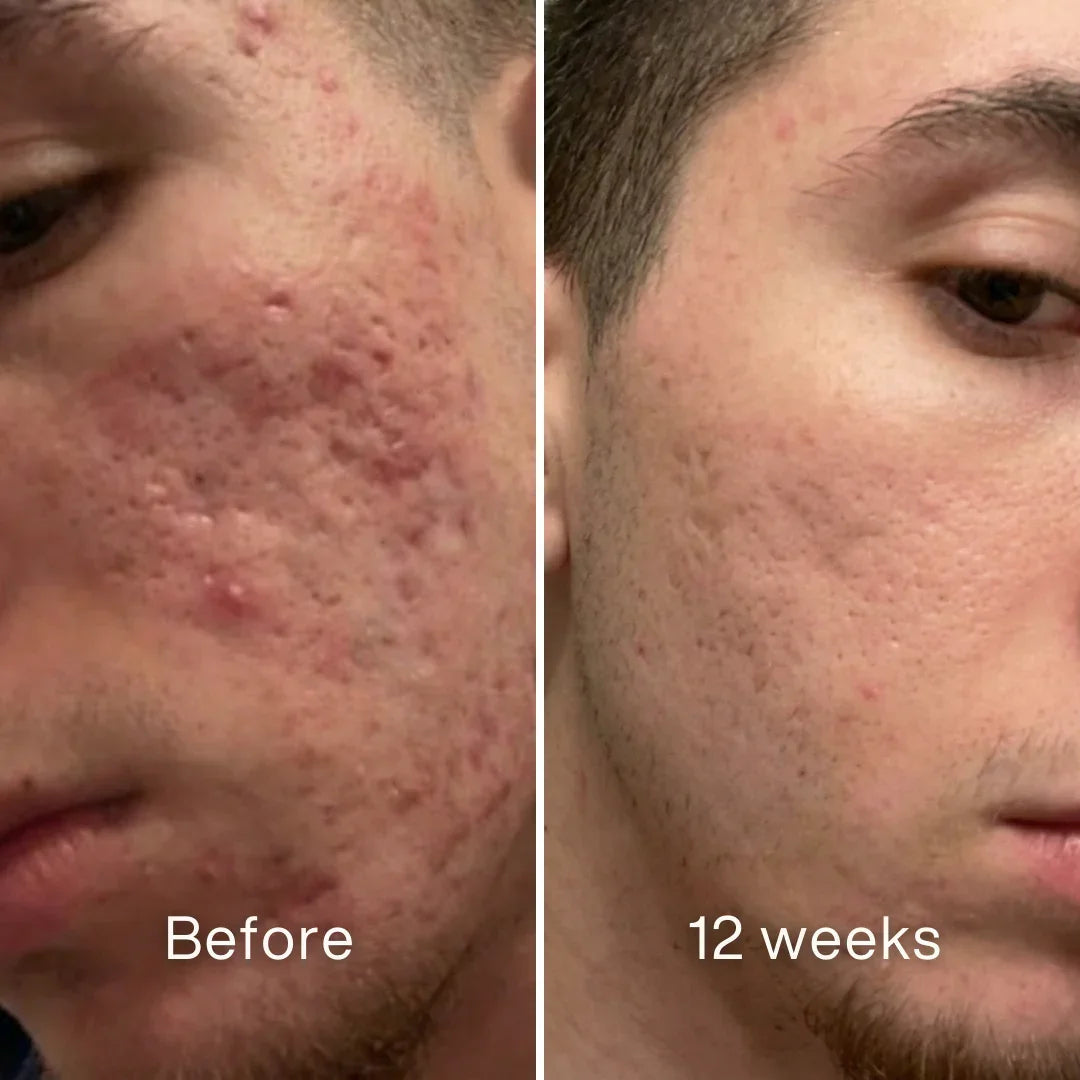 Scar Remodeling Stick