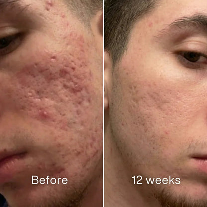 Scar Remodeling Stick