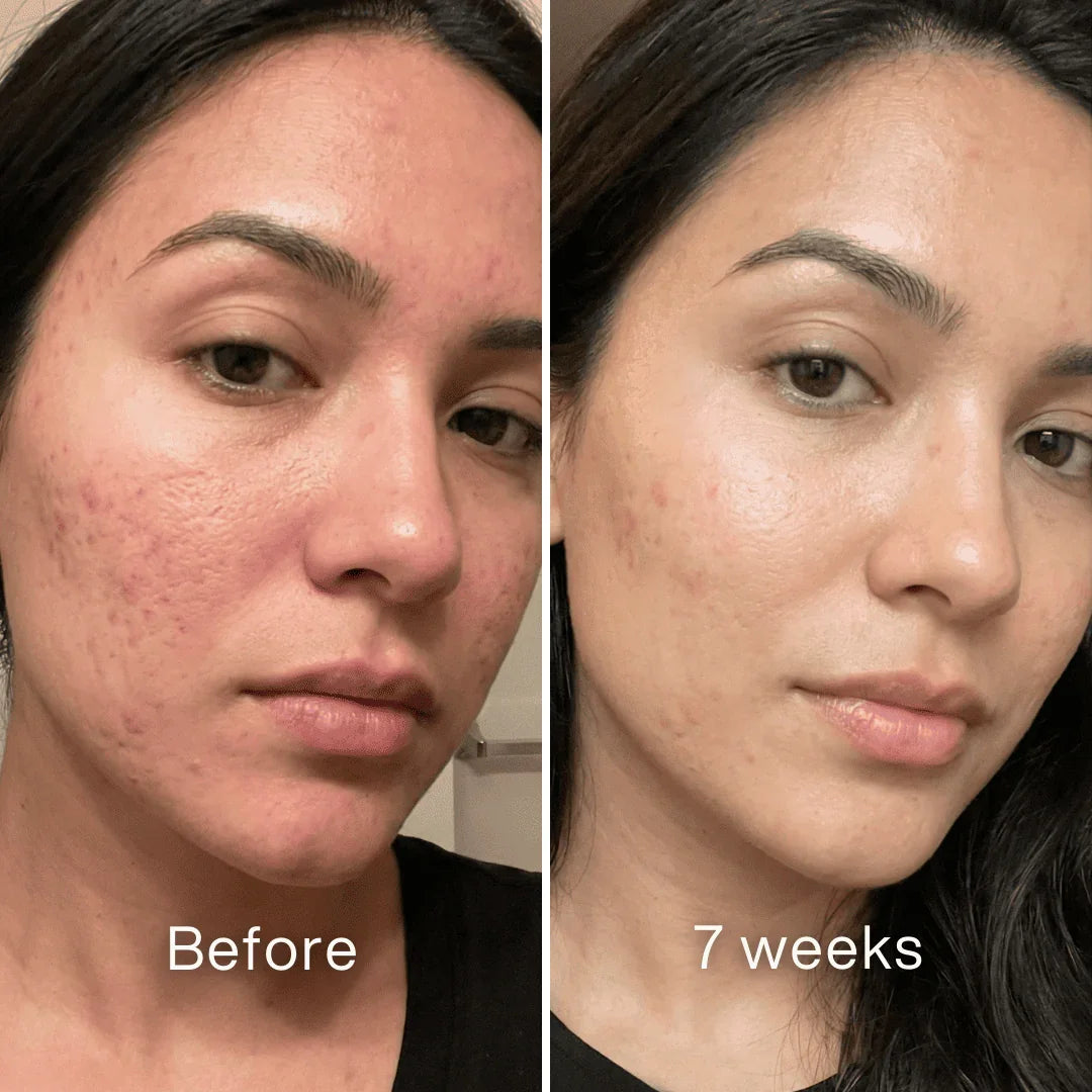 Scar Remodeling Stick