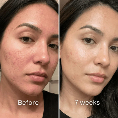 Scar Remodeling Stick